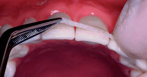 shinirovanie zubov1