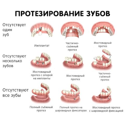 Как правильно пользоваться корегой для фиксации протезов видео и фото