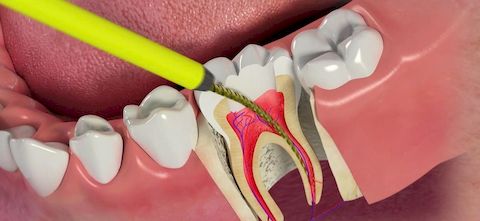 Болит зуб после удаления нерва