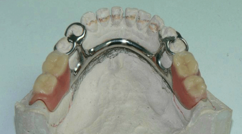 бюгельный протез зубов цена и что это такое