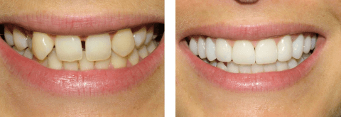 Фото зубов ДО и ПОСЛЕ, передние зубы, фото протезирования, коронки, виниры, отбеливание