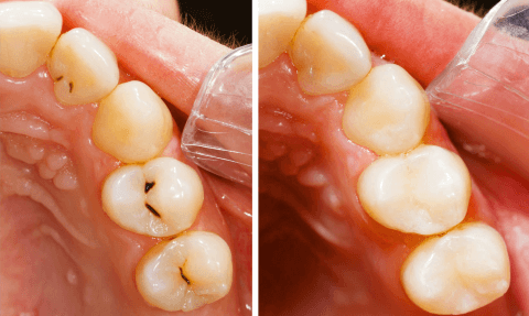 герметизировать зубы