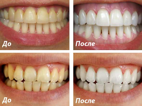 Ламинирование зубов фото до и после