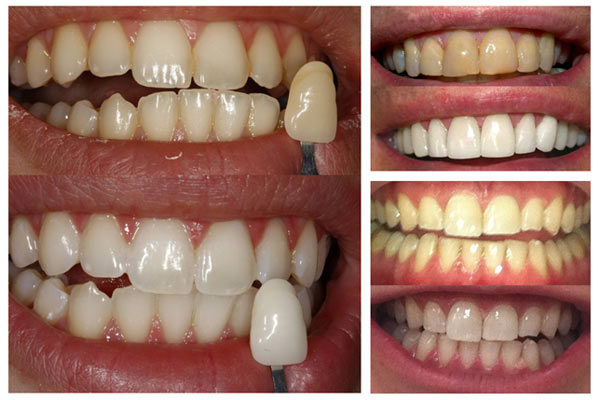 чистка зубов и отбеливание разница