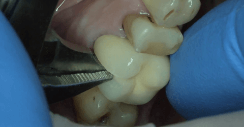 Гниет зуб под коронкой - методы лечения и симптомы