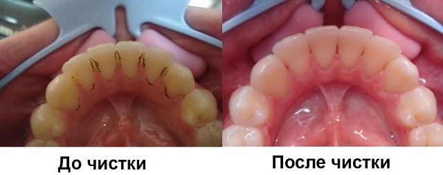ultrazvukovoe-udalenie3.jpeg