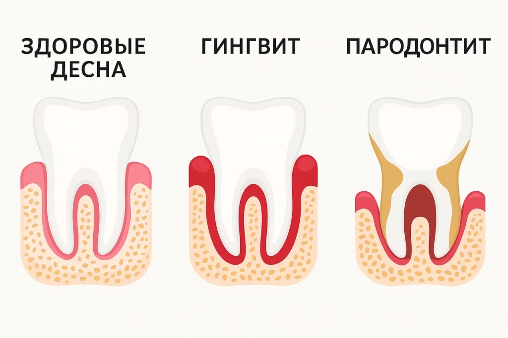 Пародонтит Пародонтит