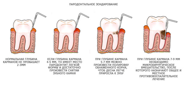 parodontologicheskaya-chistka1 parodontologicheskaya-chistka1