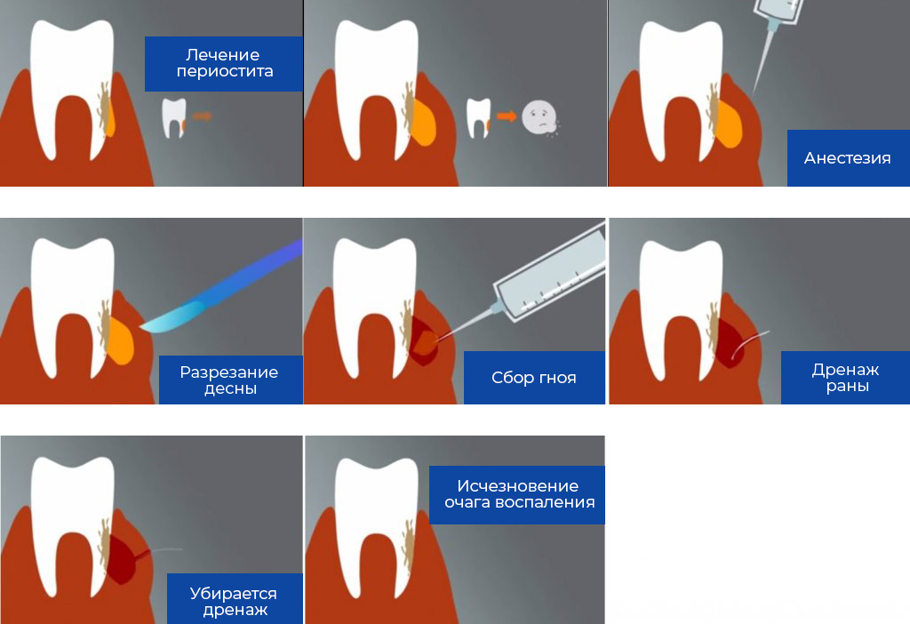 Лечение периостита Томск Западный стоматология по месту жительства томск