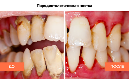 parodontologicheskaya-chistka2 parodontologicheskaya-chistka2