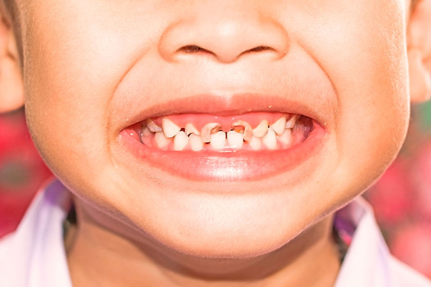Лечение молочных зубов у детей | Стоматологическая клиника 32Dent, Киев