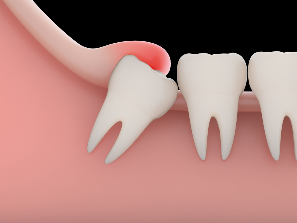 اعراض ظهور ضرس العقل ونصائح عند خلعه - موسوعة Wisdom teeth, Teeth implants, Toot