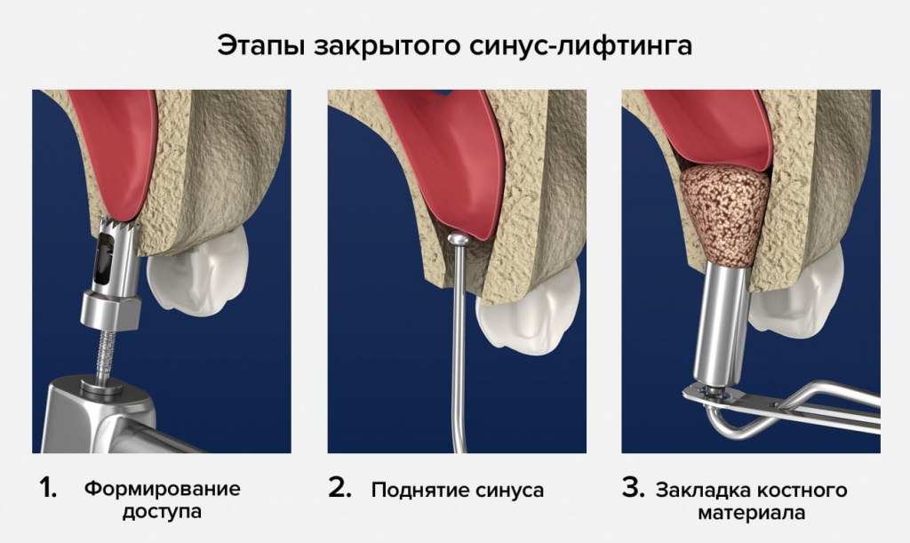 zakrytyj-sinus-lifting1 zakrytyj-sinus-lifting1
